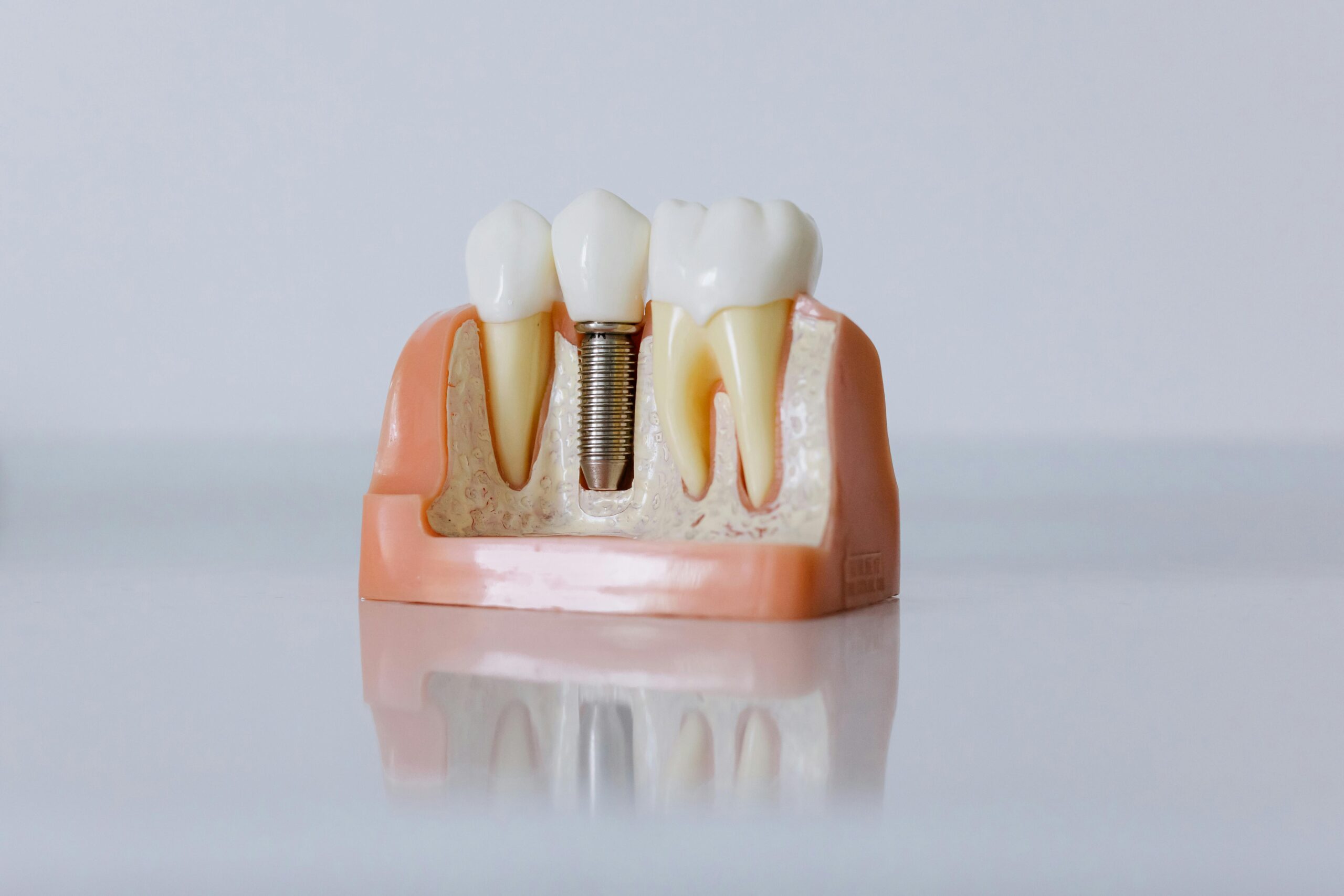 implant dentar